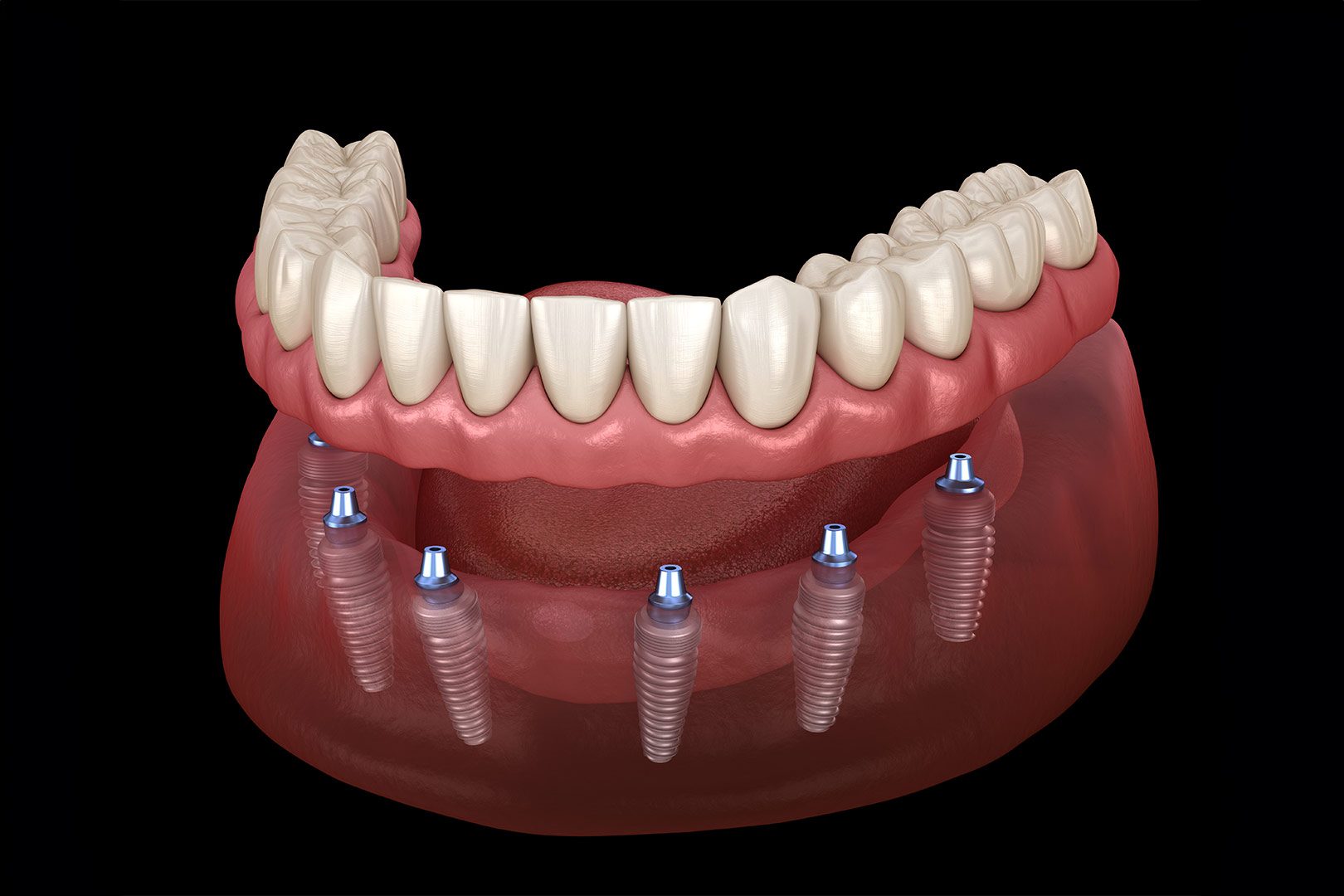 All on x Implant | Prairie Dental | General & Family Dentist | Leduc, AB
