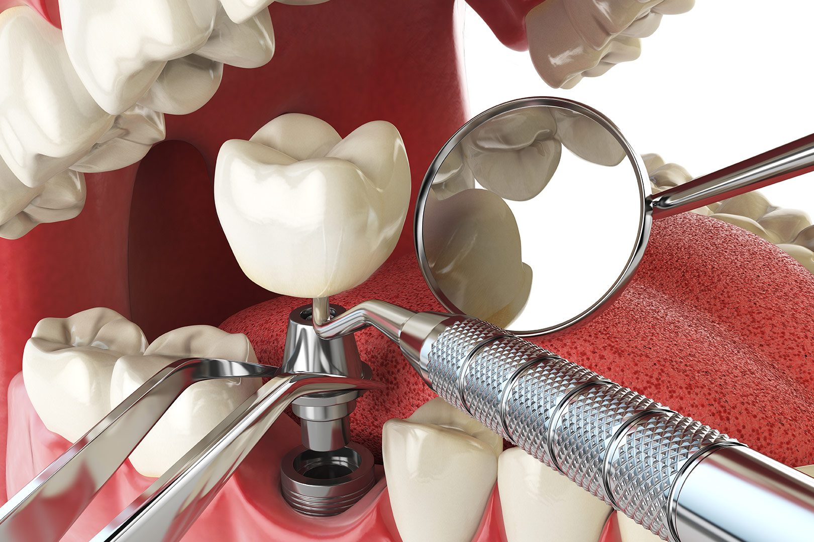 Dental implant placement surgery | Prairie Dental | General & Family Dentist | Leduc, AB